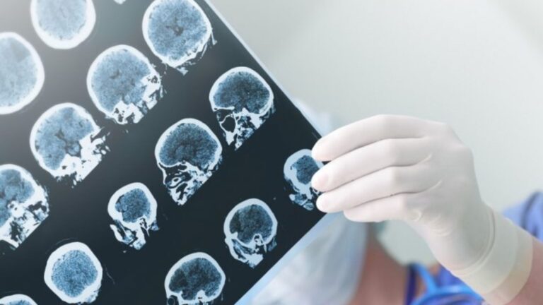 Nueva IA halla lesiones cerebrales en epilepsia infantil